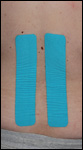 Kinesioteippaus